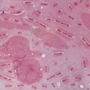Klebsiella pneumoniae in pneumonia